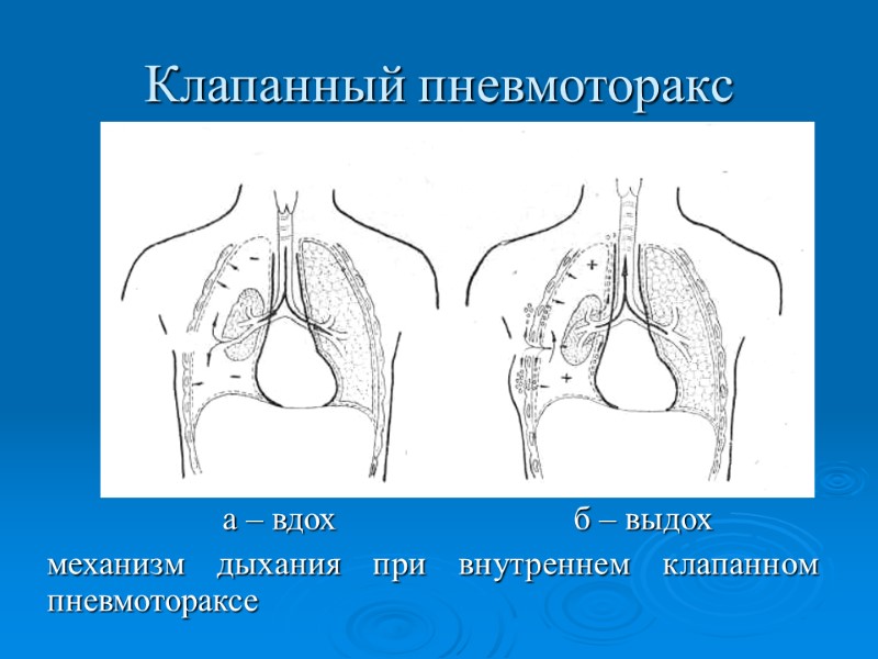 Клапанный пневмоторакс   а – вдох   б – выдох механизм дыхания